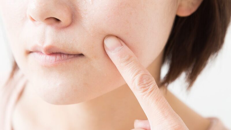 女性が頬のシミを気にしている写真